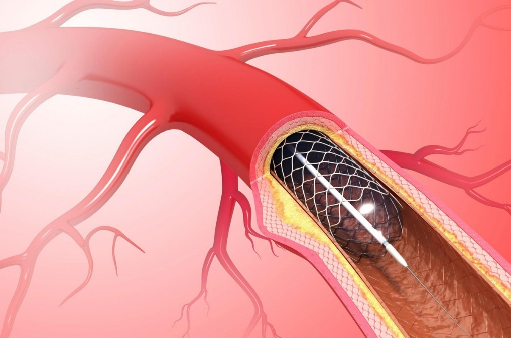 Coronary-Angioplasty (1)