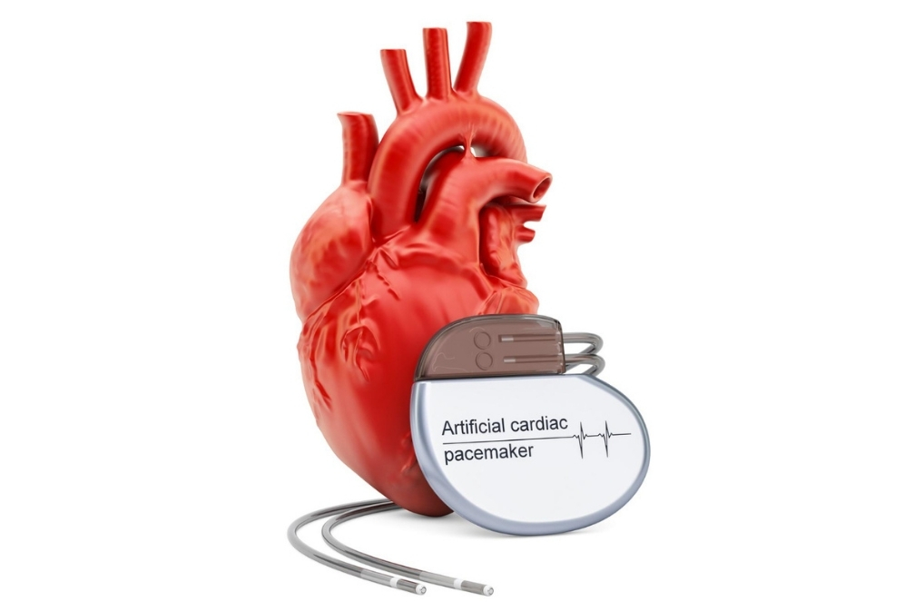 Pacemaker-Implantation